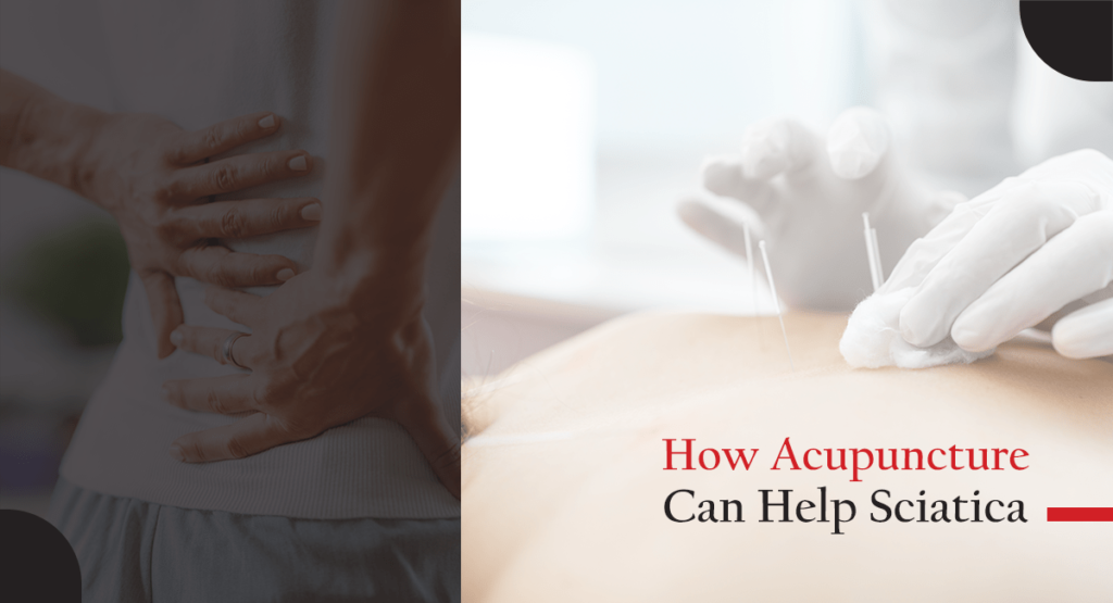 How Acupuncture Can Help Sciatica min
